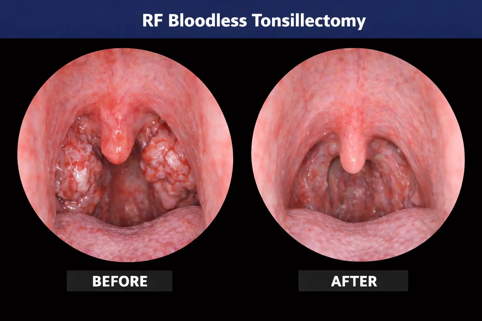 RF Tonsillectomy