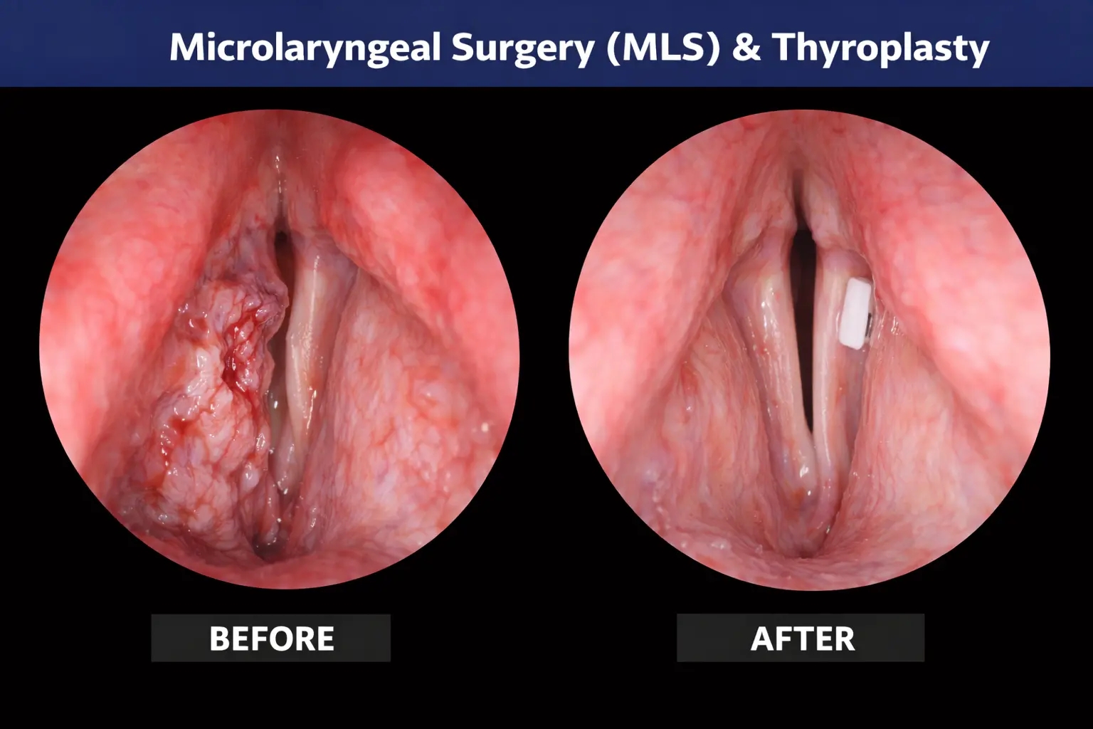 Microlaryngeal Surgery